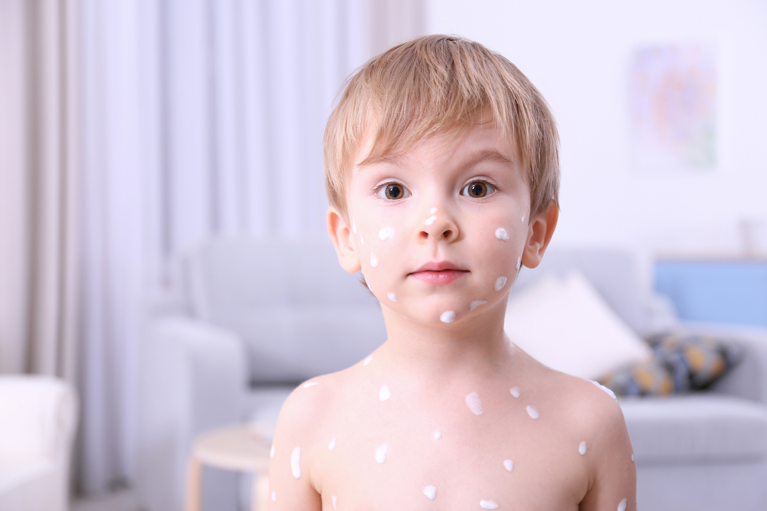 Home remedies to treat chickenpox