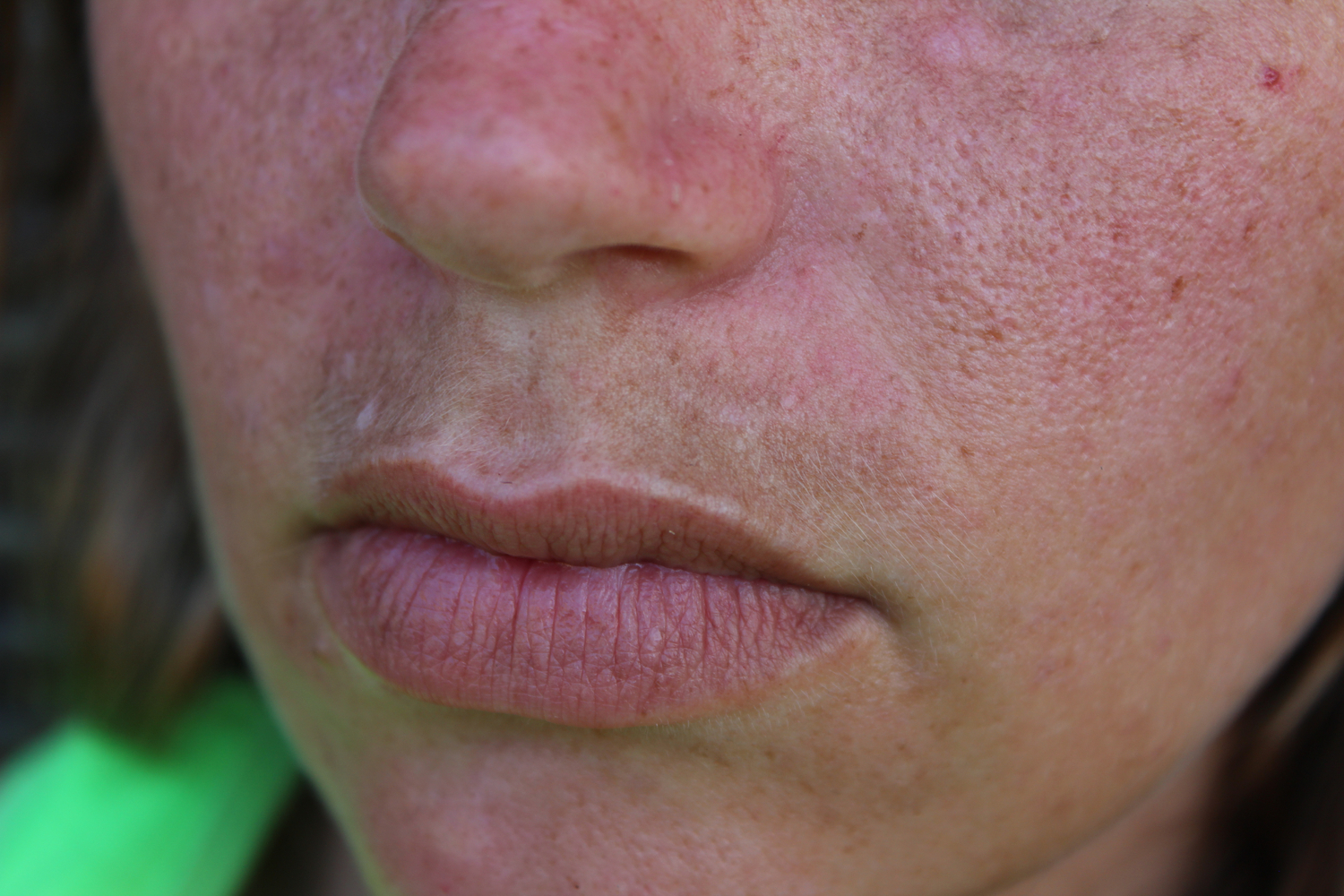 5 Lupus Symptoms in Women that Affect the Whole Body