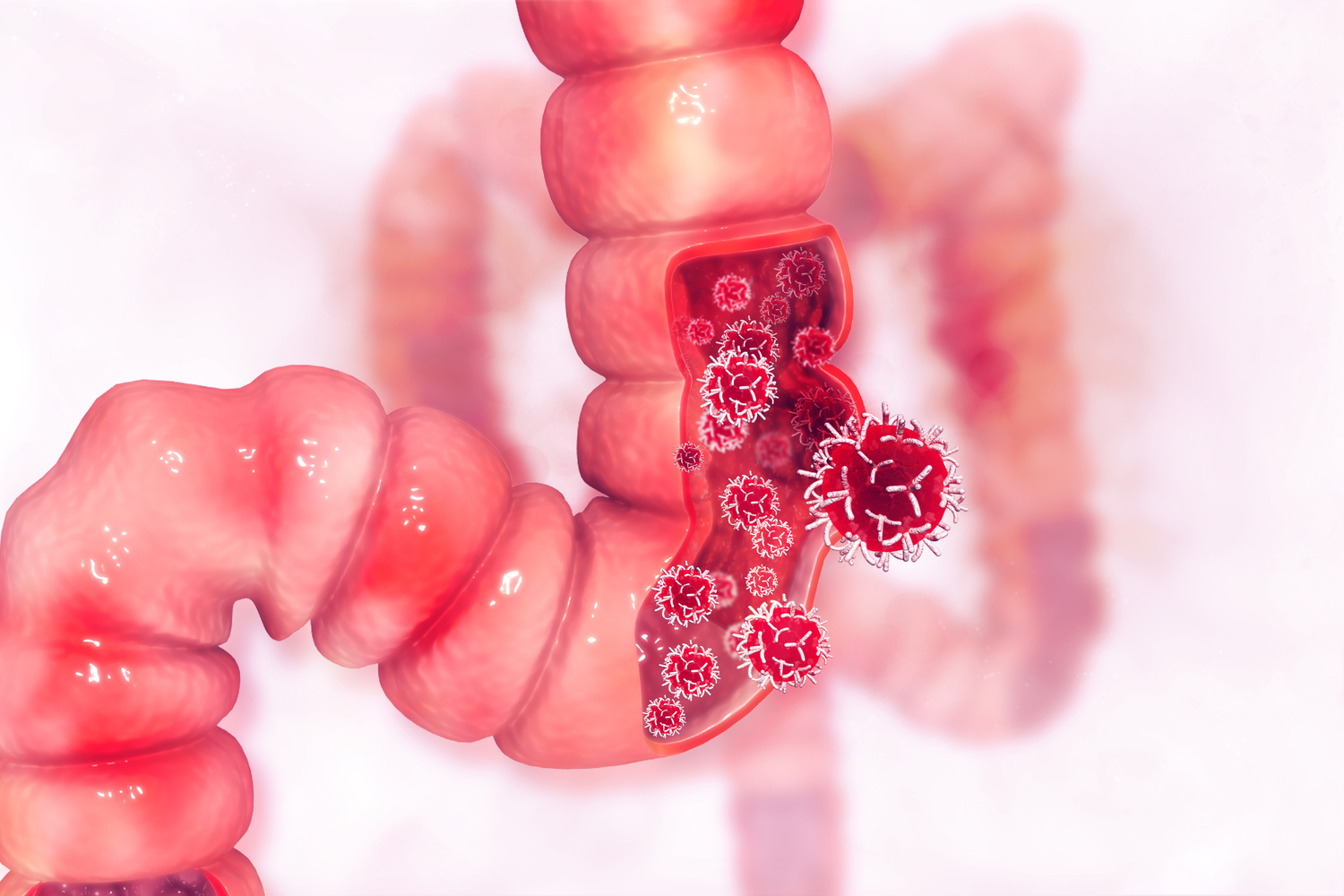 6 Early Symptoms of Colon Cancer